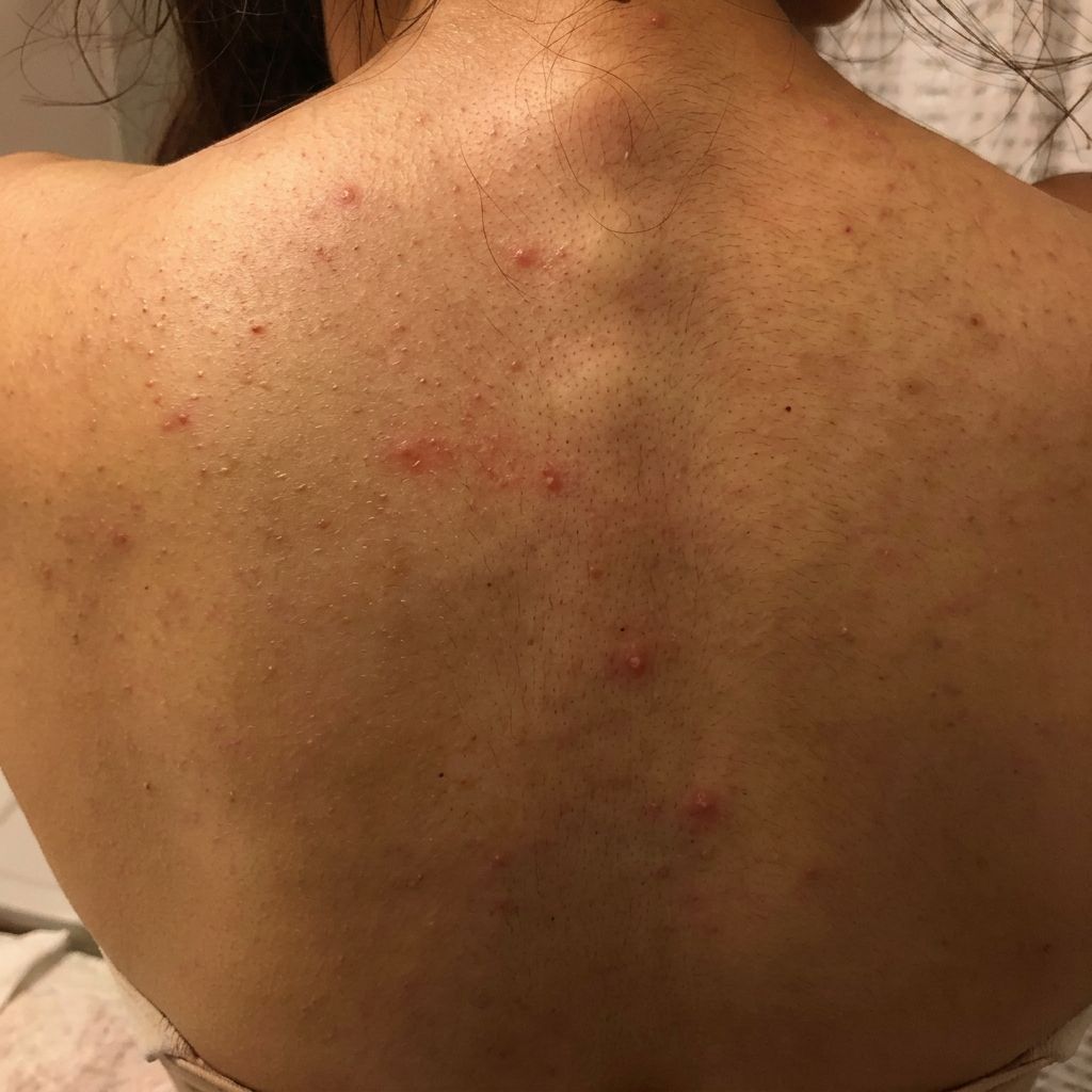Skin & body before and after switching to filtered shower water — before